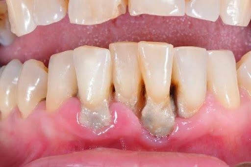 doencaperiodontal